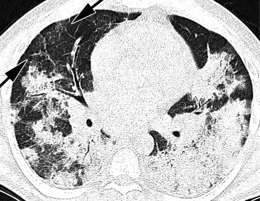 Thin-section CT image at the level of the right middle lobar bronchus